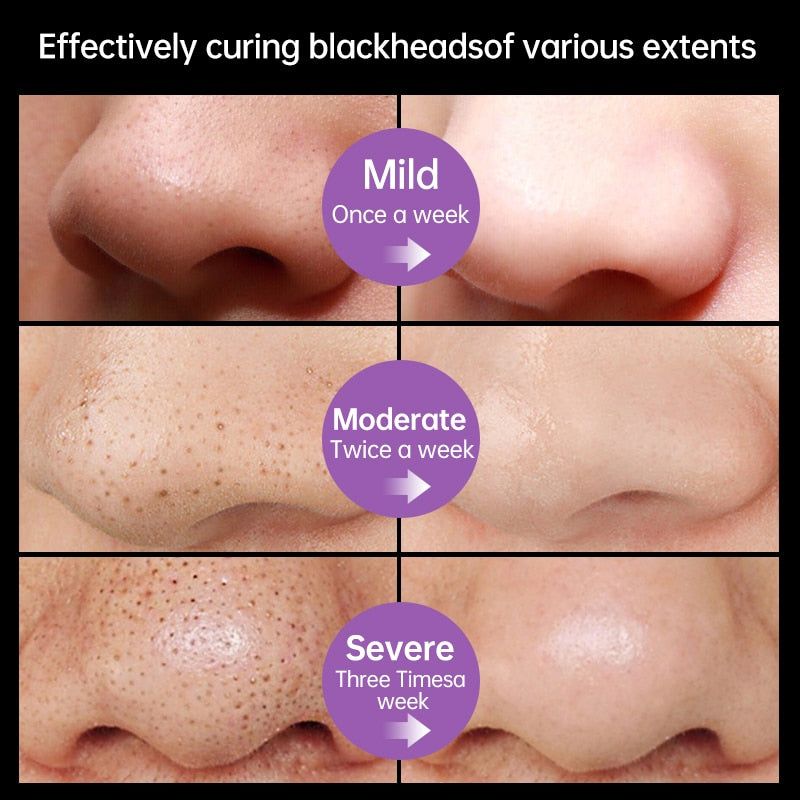 Máscara Mágica Facial Preta Removível de Blackhead-Promoção de Lançamento