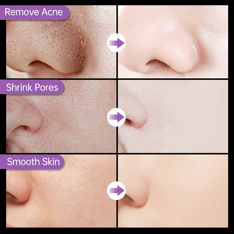 Máscara Mágica Facial Preta Removível de Blackhead-Promoção de Lançamento