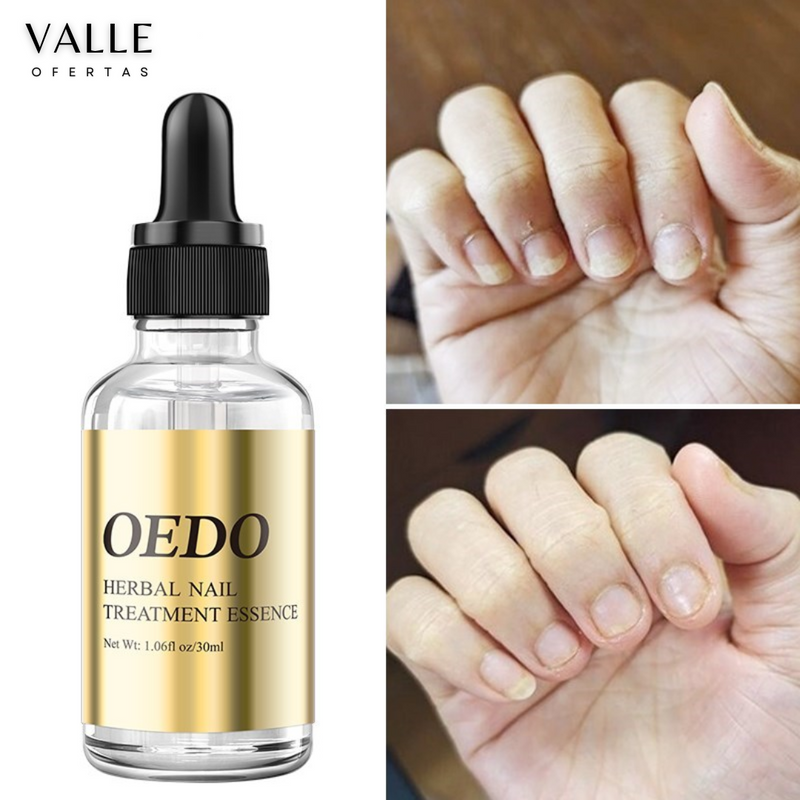 Óleo para Unhas Anti Fungos [FRETE GRÁTIS]